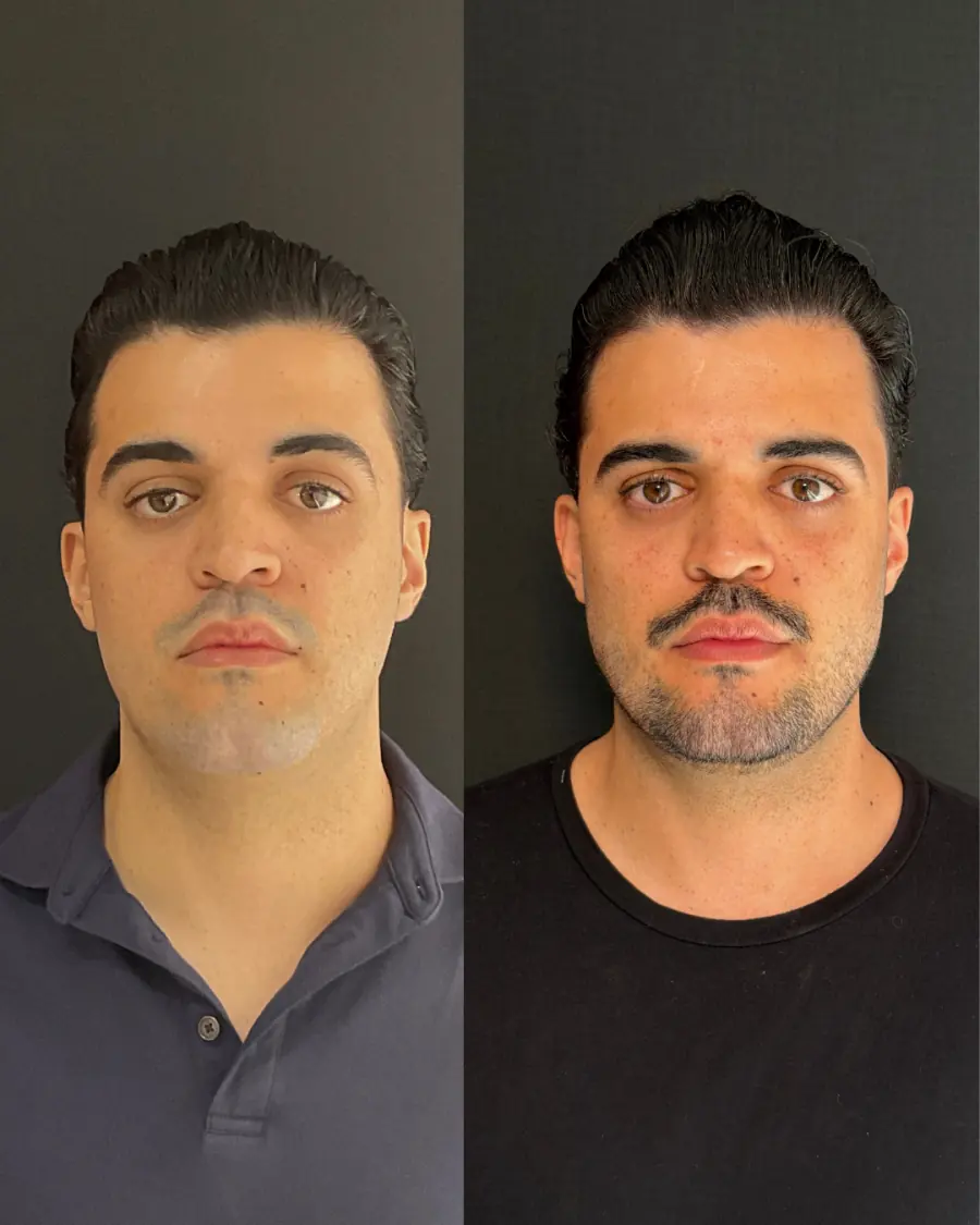 Antes e depois do tratamento — caso 1