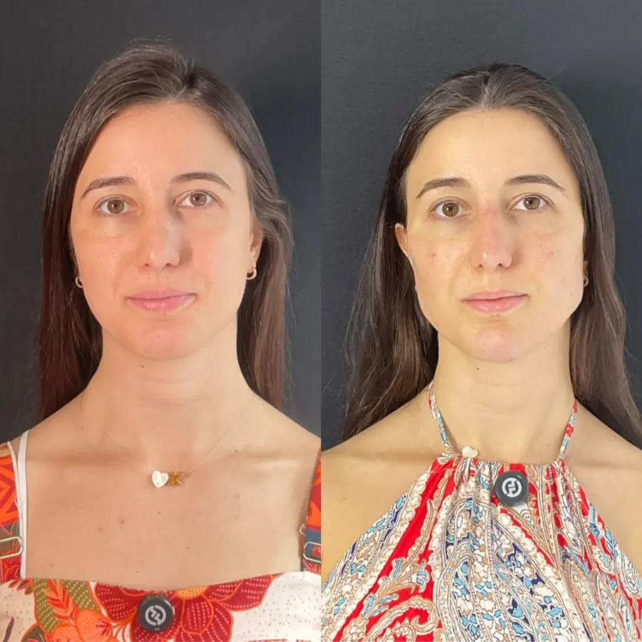 Antes e depois do tratamento — caso 3