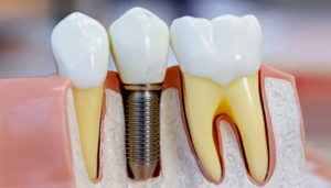 Implantes Dentários​